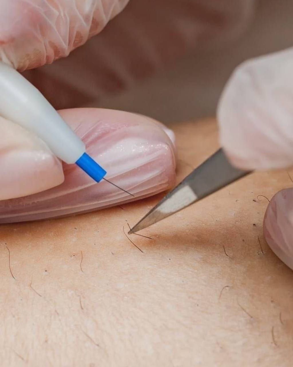 Nahaufnahme einer Elektroepilation im Ariona-Beauty-Studio Kassel: Hände in weißen Handschuhen führen die feine Sonde präzise an einzelne Härchen im Wangenbereich